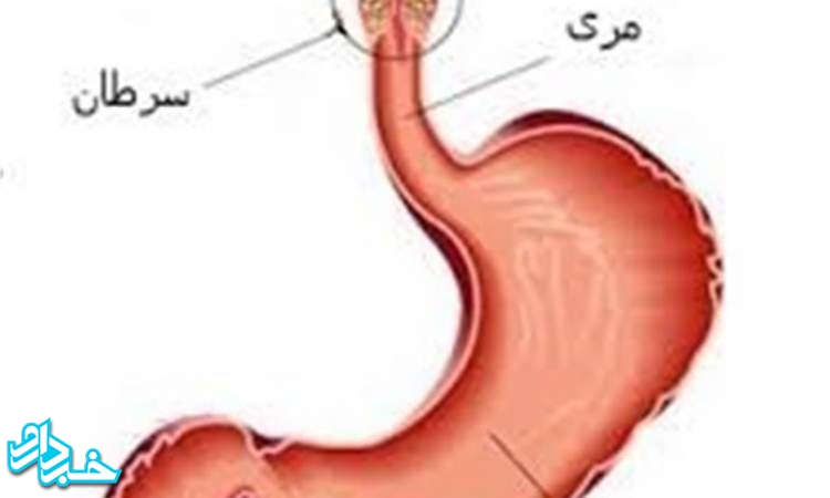 سرطان مری دومین سرطان شایع در گلستان است